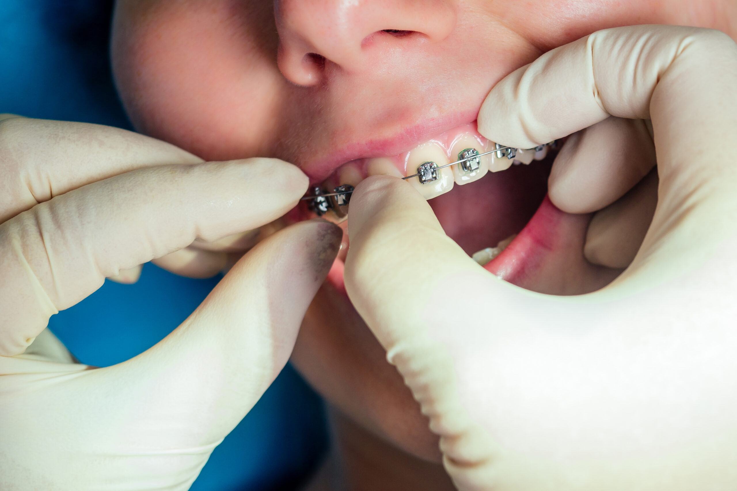 airway orthodontics in otsego